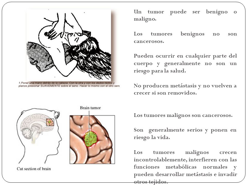 Un tumor puede ser benigno o maligno.