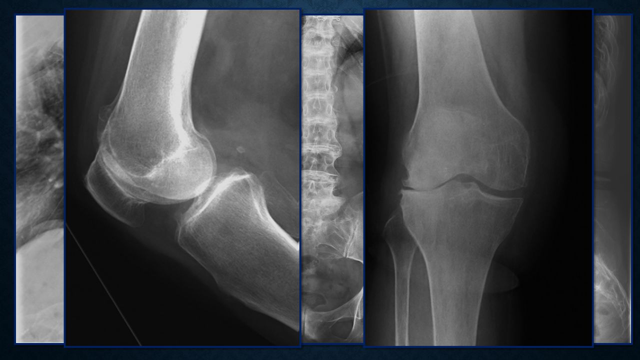 Rx de columna vertebral torácica lateral: Muestra osteopenia, amplia/extensa calcificación de los discos y estrechamiento de los espacios intervertebrales.