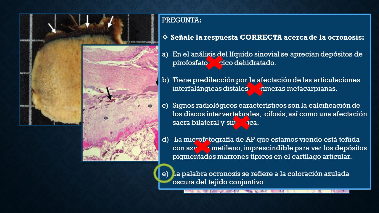 Señale la respuesta CORRECTA acerca de la ocronosis: