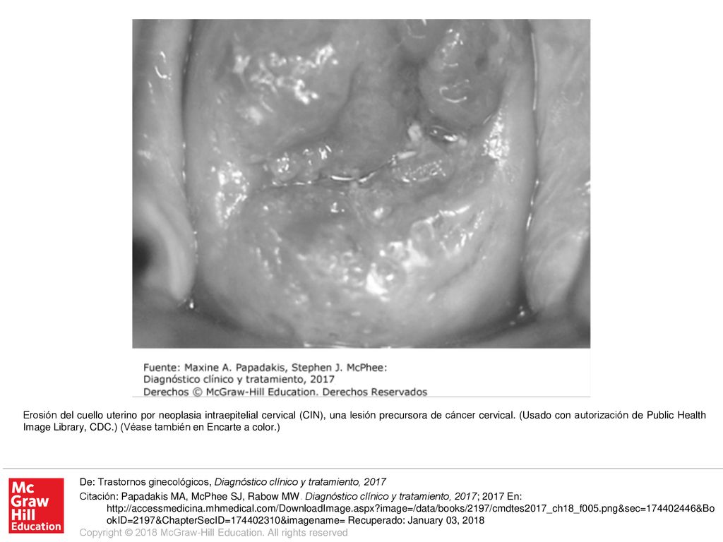 Erosión del cuello uterino por neoplasia intraepitelial cervical (CIN), una lesión precursora de cáncer cervical. (Usado con autorización de Public Health Image Library, CDC.) (Véase también en Encarte a color.)