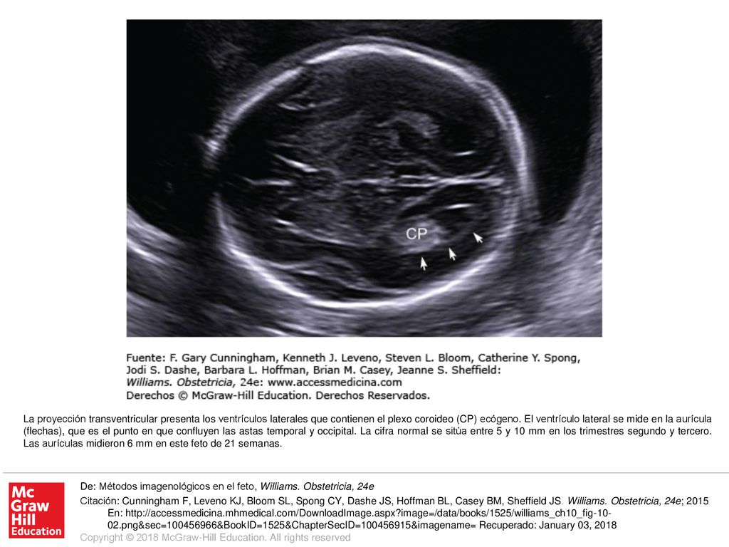La proyección transventricular presenta los ventrículos laterales que contienen el plexo coroideo (CP) ecógeno. El ventrículo lateral se mide en la aurícula (flechas), que es el punto en que confluyen las astas temporal y occipital. La cifra normal se sitúa entre 5 y 10 mm en los trimestres segundo y tercero. Las aurículas midieron 6 mm en este feto de 21 semanas.