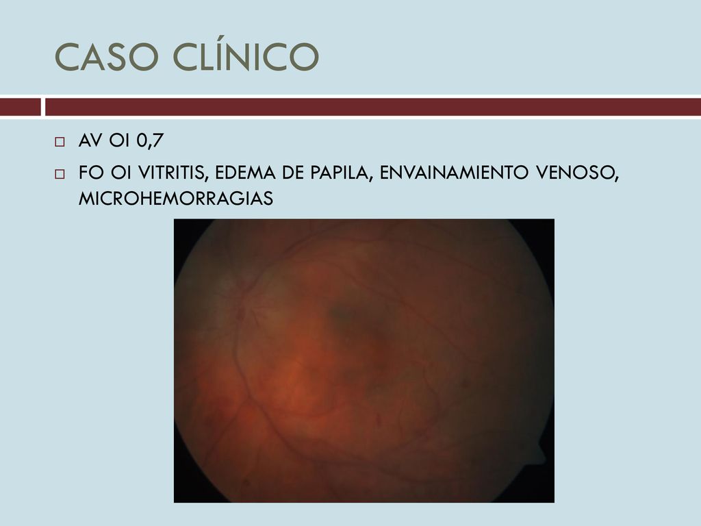 CASO CLÍNICO AV OI 0,7 FO OI VITRITIS, EDEMA DE PAPILA, ENVAINAMIENTO VENOSO, MICROHEMORRAGIAS
