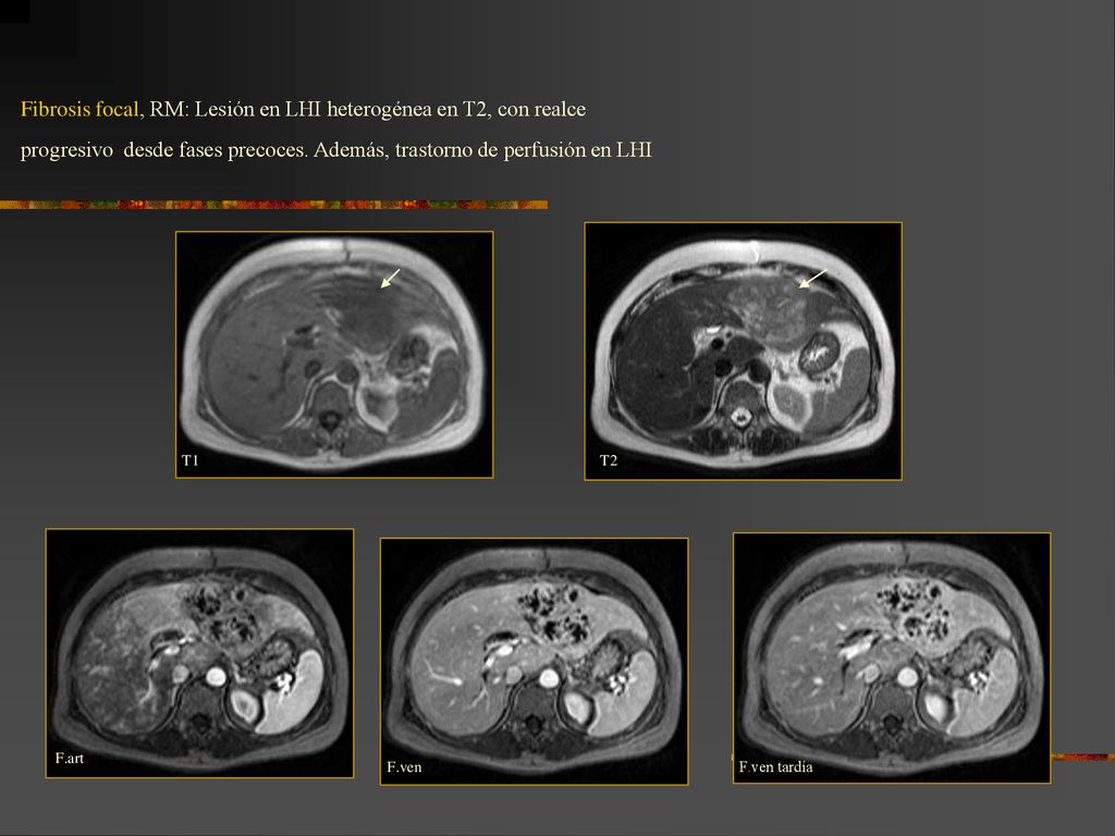 Fibrosis focal, RM: Lesión en LHI heterogénea en T2, con realce progresivo desde fases precoces. Además, trastorno de perfusión en LHI