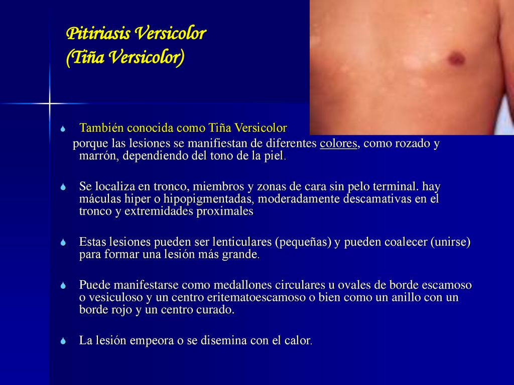 Pitiriasis Versicolor (Tiña Versicolor)