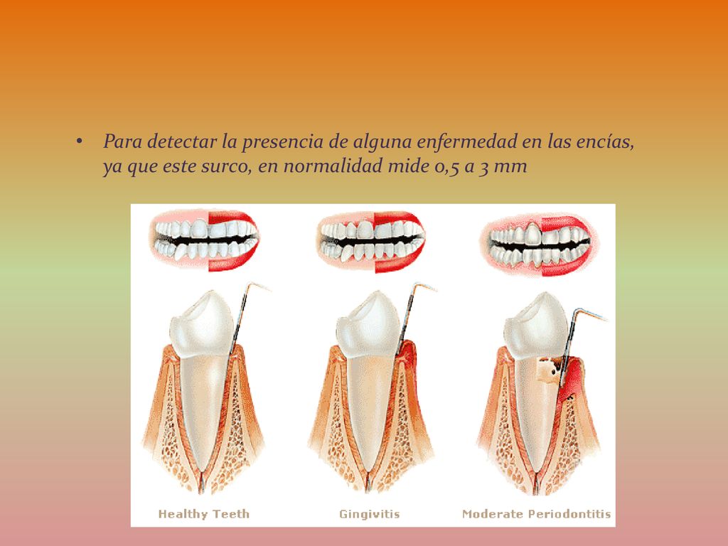 Para detectar la presencia de alguna enfermedad en las encías, ya que este surco, en normalidad mide 0,5 a 3 mm