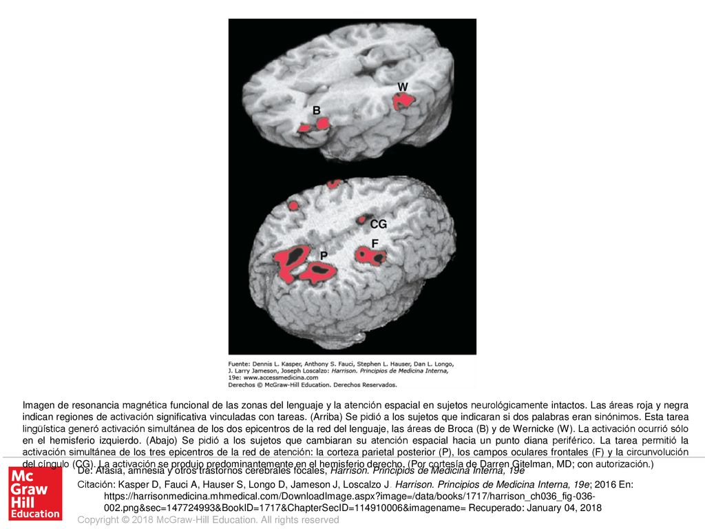 Imagen de resonancia magnética funcional de las zonas del lenguaje y la atención espacial en sujetos neurológicamente intactos. Las áreas roja y negra indican regiones de activación significativa vinculadas con tareas. (Arriba) Se pidió a los sujetos que indicaran si dos palabras eran sinónimos. Esta tarea lingüística generó activación simultánea de los dos epicentros de la red del lenguaje, las áreas de Broca (B) y de Wernicke (W). La activación ocurrió sólo en el hemisferio izquierdo. (Abajo) Se pidió a los sujetos que cambiaran su atención espacial hacia un punto diana periférico. La tarea permitió la activación simultánea de los tres epicentros de la red de atención: la corteza parietal posterior (P), los campos oculares frontales (F) y la circunvolución del cíngulo (CG). La activación se produjo predominantemente en el hemisferio derecho. (Por cortesía de Darren Gitelman, MD; con autorización.)