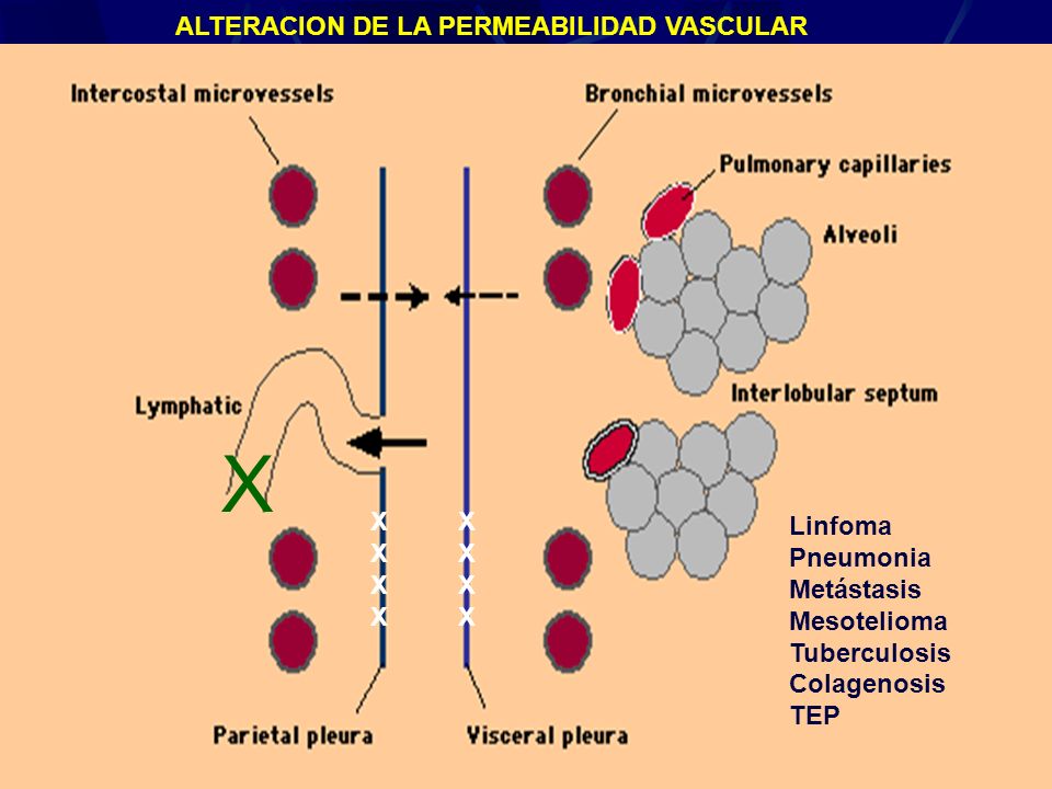 X ALTERACION DE LA PERMEABILIDAD VASCULAR X X Linfoma Pneumonia