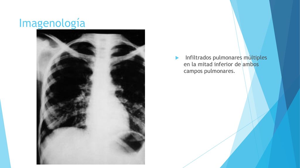 Imagenología Infiltrados pulmonares múltiples en la mitad inferior de ambos campos pulmonares.