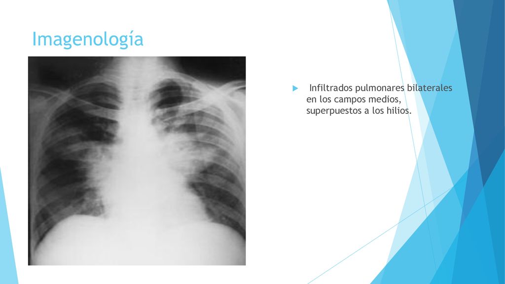 Imagenología Infiltrados pulmonares bilaterales en los campos medios, superpuestos a los hilios.