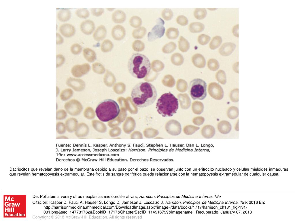Dacriocitos que revelan daño de la membrana debido a su paso por el bazo; se observan junto con un eritrocito nucleado y células mieloides inmaduras que revelan hematopoyesis extramedular. Este frotis de sangre periférica puede relacionarse con la hematopoyesis extramedular de cualquier causa.