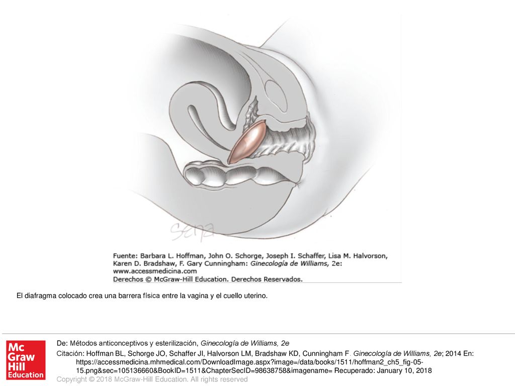 El diafragma colocado crea una barrera física entre la vagina y el cuello uterino.
