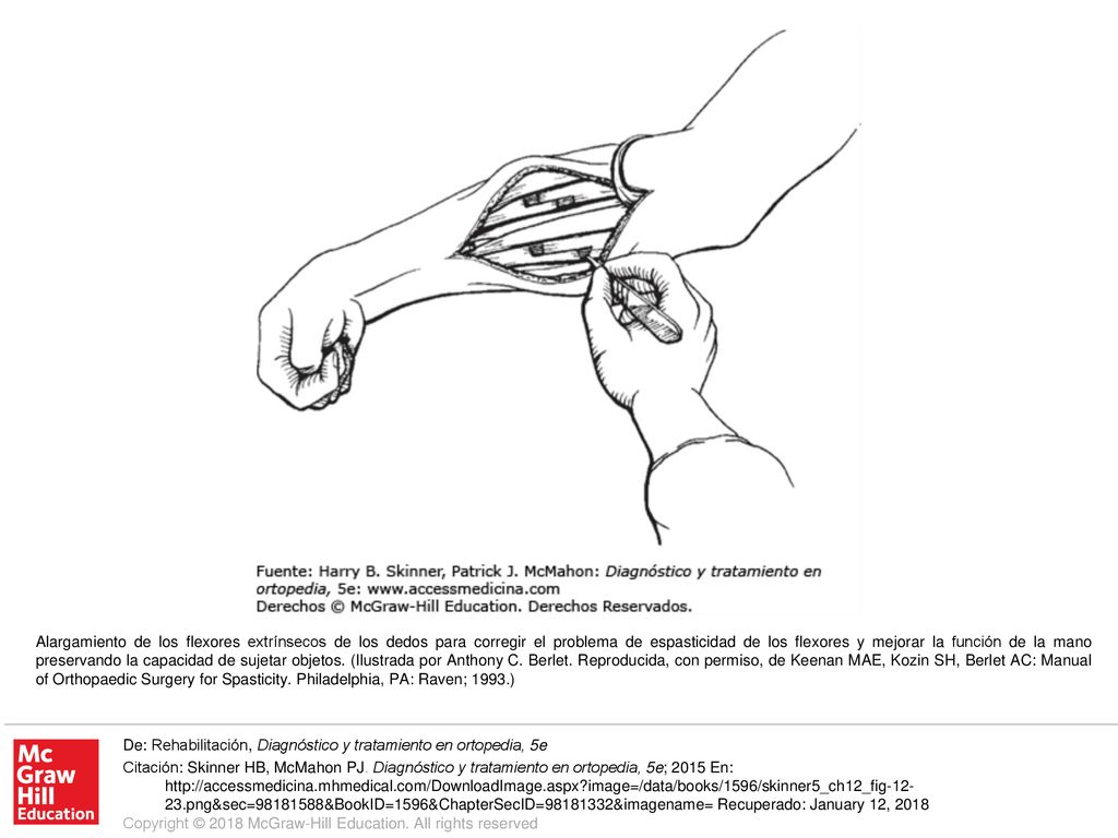 Alargamiento de los flexores extrínsecos de los dedos para corregir el problema de espasticidad de los flexores y mejorar la función de la mano preservando la capacidad de sujetar objetos. (Ilustrada por Anthony C. Berlet. Reproducida, con permiso, de Keenan MAE, Kozin SH, Berlet AC: Manual of Orthopaedic Surgery for Spasticity. Philadelphia, PA: Raven; 1993.)