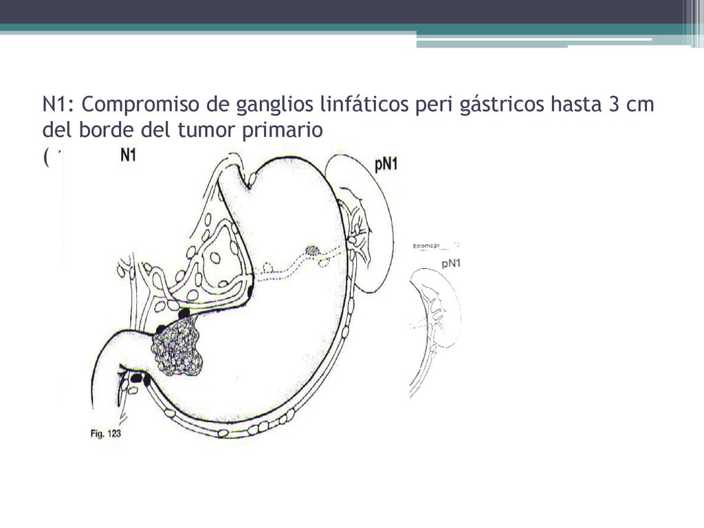 N1: Compromiso de ganglios linfáticos peri gástricos hasta 3 cm del borde del tumor primario ( 1-6 GANGLIOS)