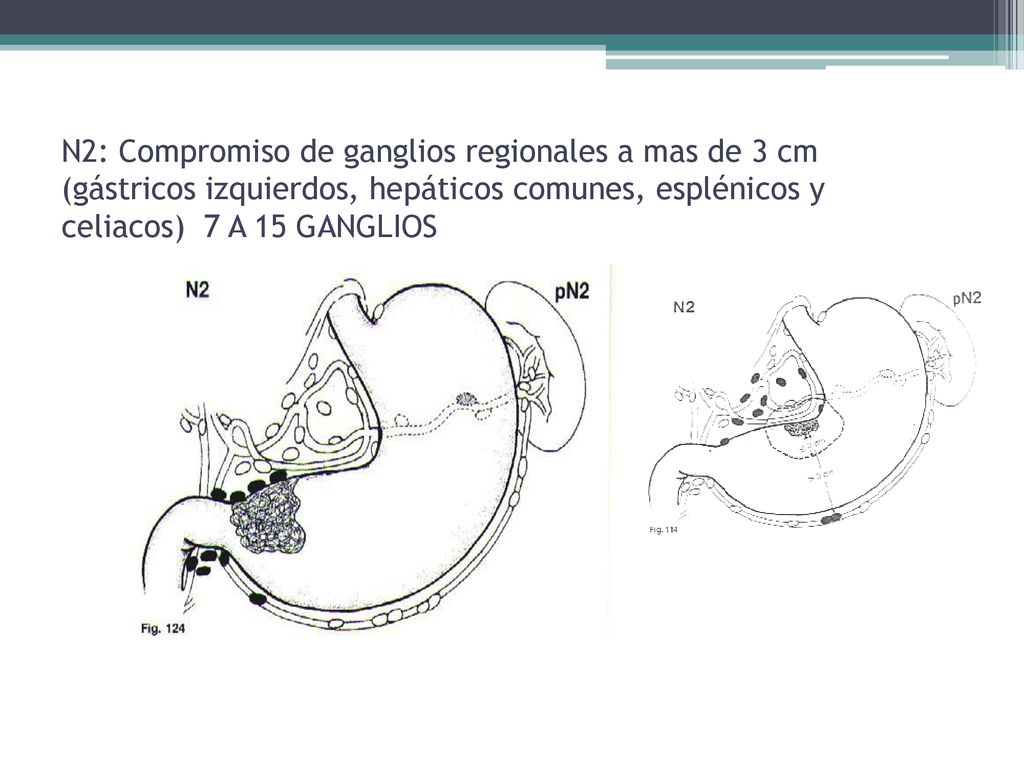 N2: Compromiso de ganglios regionales a mas de 3 cm (gástricos izquierdos, hepáticos comunes, esplénicos y celiacos) 7 A 15 GANGLIOS