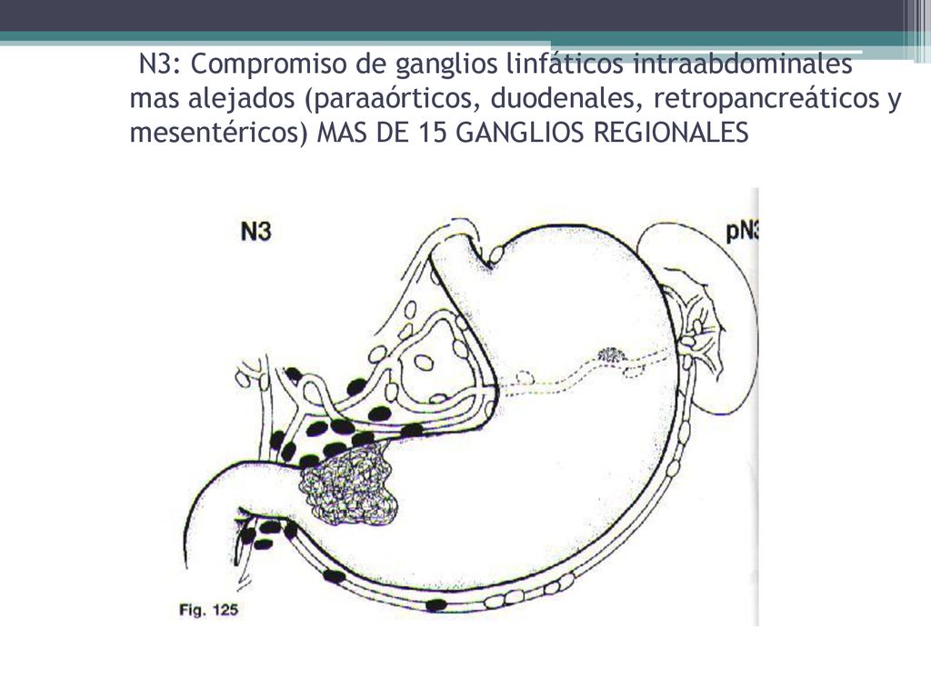 N3: Compromiso de ganglios linfáticos intraabdominales mas alejados (paraaórticos, duodenales, retropancreáticos y mesentéricos) MAS DE 15 GANGLIOS REGIONALES