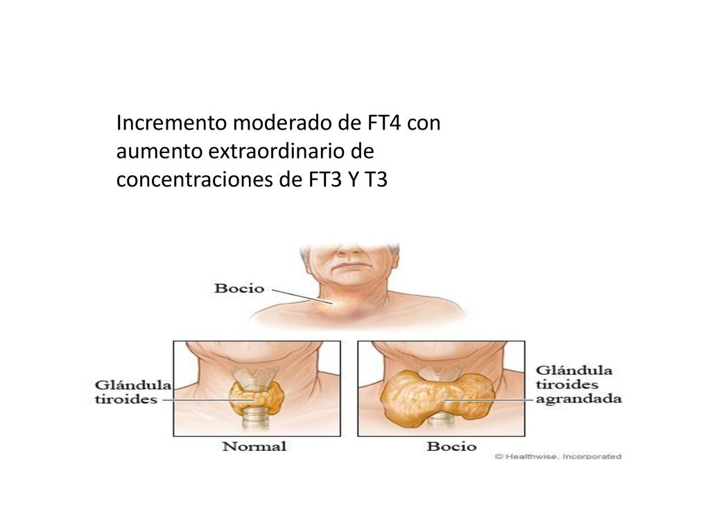 Incremento moderado de FT4 con aumento extraordinario de concentraciones de FT3 Y T3