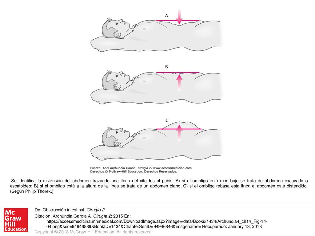 Se identifica la distensión del abdomen trazando una línea del xifoides al pubis: A) si el ombligo está más bajo se trata de abdomen excavado o escafoideo; B) si el ombligo está a la altura de la línea se trata de un abdomen plano; C) si el ombligo rebasa esta línea el abdomen está distendido. (Según Philip Thorek.)