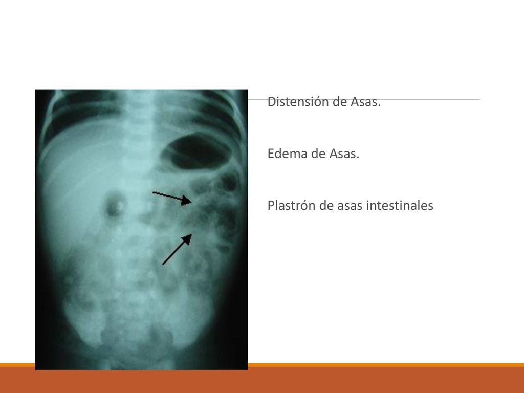 Distensión de Asas. Edema de Asas. Plastrón de asas intestinales
