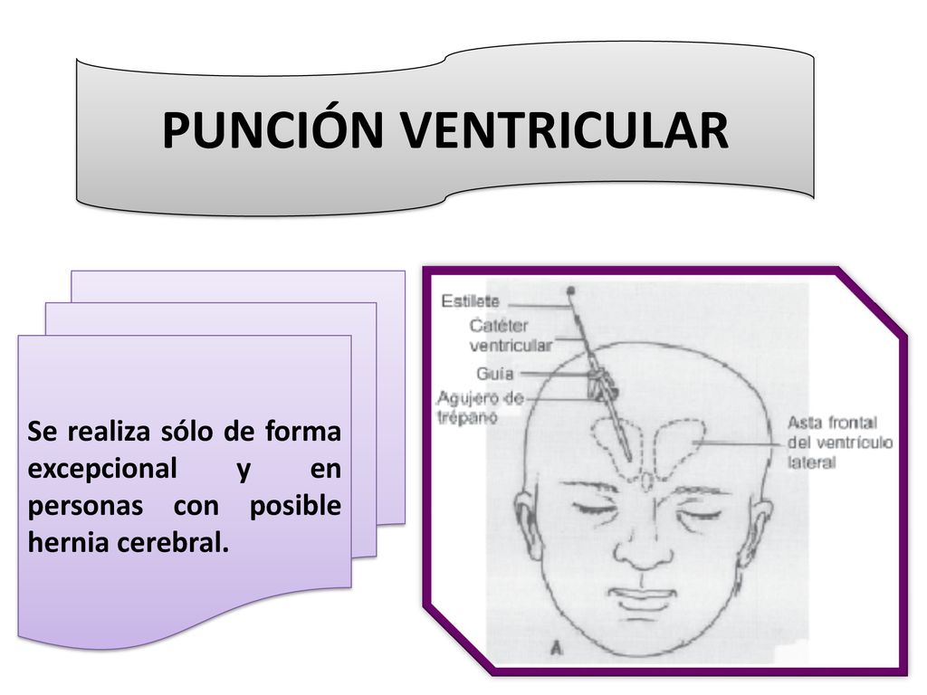 PUNCIÓN VENTRICULAR Se realiza sólo de forma excepcional y en personas con posible hernia cerebral.