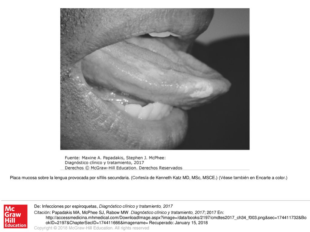 Placa mucosa sobre la lengua provocada por sífilis secundaria