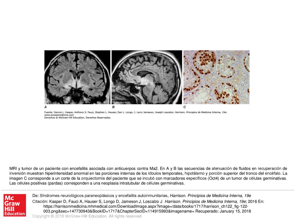 MRI y tumor de un paciente con encefalitis asociada con anticuerpos contra Ma2. En A y B las secuencias de atenuación de fluidos en recuperación de inversión muestran hiperintensidad anormal en las porciones internas de los lóbulos temporales, hipotálamo y porción superior del tronco del encéfalo. La imagen C corresponde a un corte de la orquiectomía del paciente que se incubó con marcadores específicos (Oct4) de un tumor de células germinativas. Las células positivas (pardas) corresponden a una neoplasia intratubular de células germinativas.