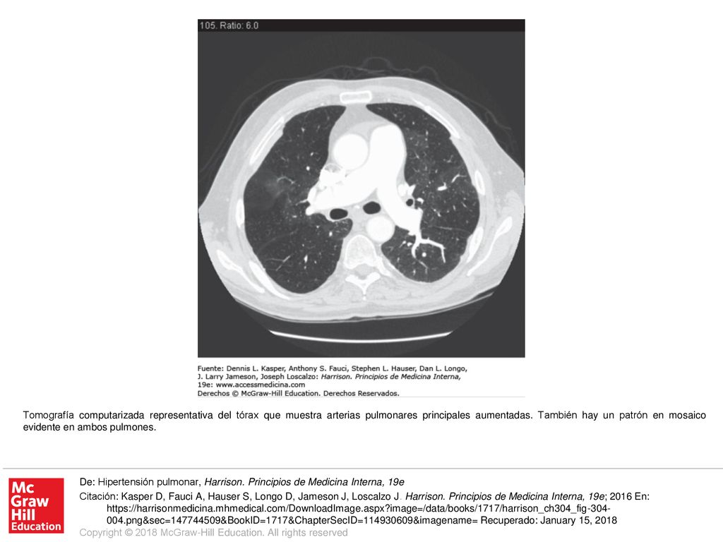 Tomografía computarizada representativa del tórax que muestra arterias pulmonares principales aumentadas. También hay un patrón en mosaico evidente en ambos pulmones.