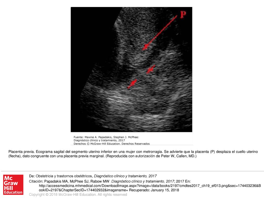 Placenta previa. Ecograma sagital del segmento uterino inferior en una mujer con metrorragia. Se advierte que la placenta (P) desplaza el cuello uterino (flecha), dato congruente con una placenta previa marginal. (Reproducida con autorización de Peter W, Callen, MD.)