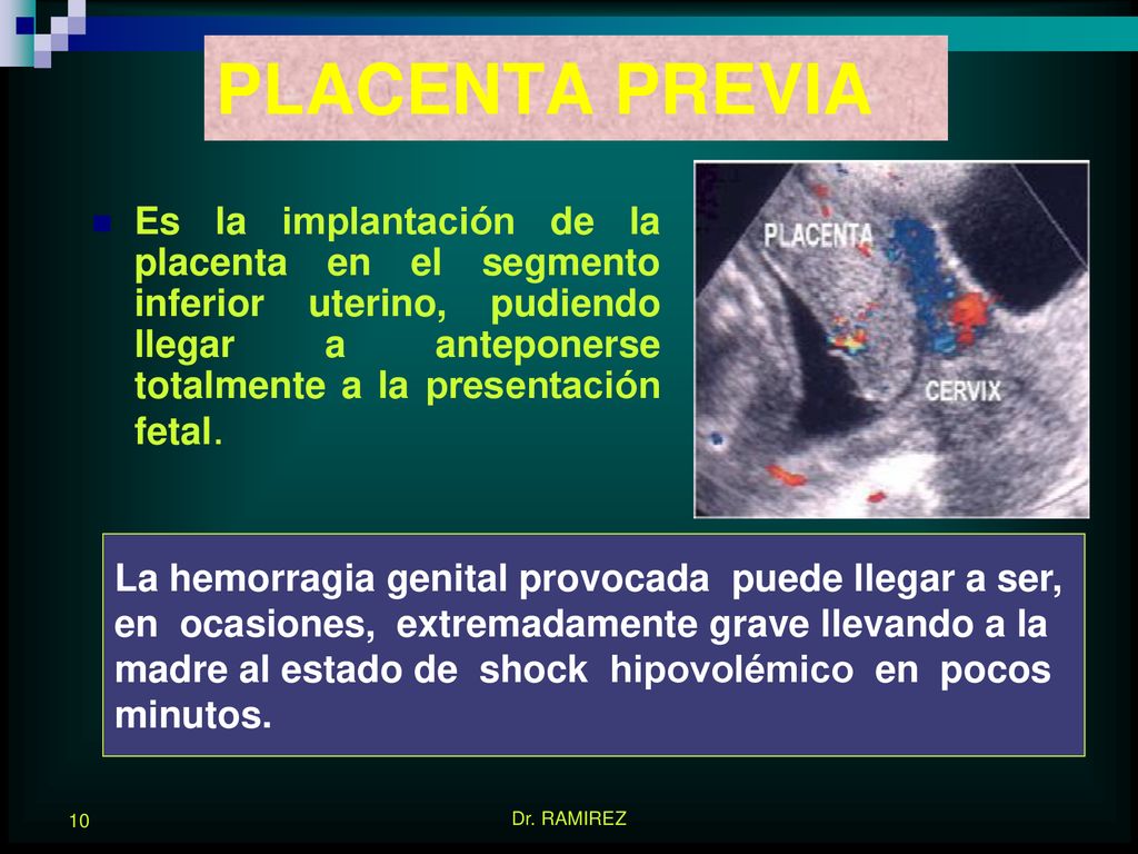 PLACENTA PREVIA Es la implantación de la placenta en el segmento inferior uterino, pudiendo llegar a anteponerse totalmente a la presentación fetal.