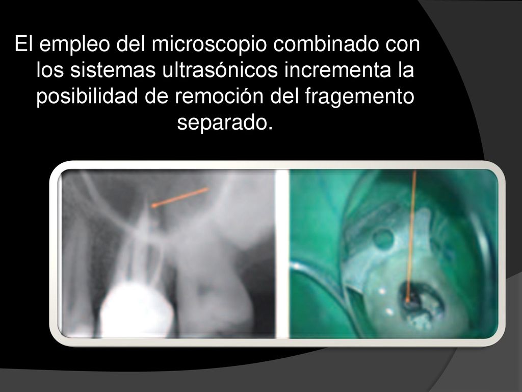 El empleo del microscopio combinado con los sistemas ultrasónicos incrementa la posibilidad de remoción del fragemento separado.