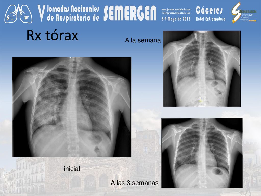 Rx tórax A la semana inicial A las 3 semanas