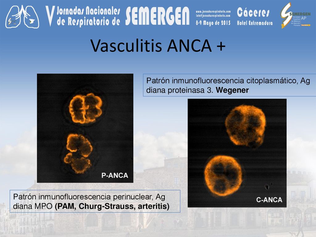 Vasculitis ANCA + Patrón inmunofluorescencia citoplasmático, Ag diana proteinasa 3. Wegener.