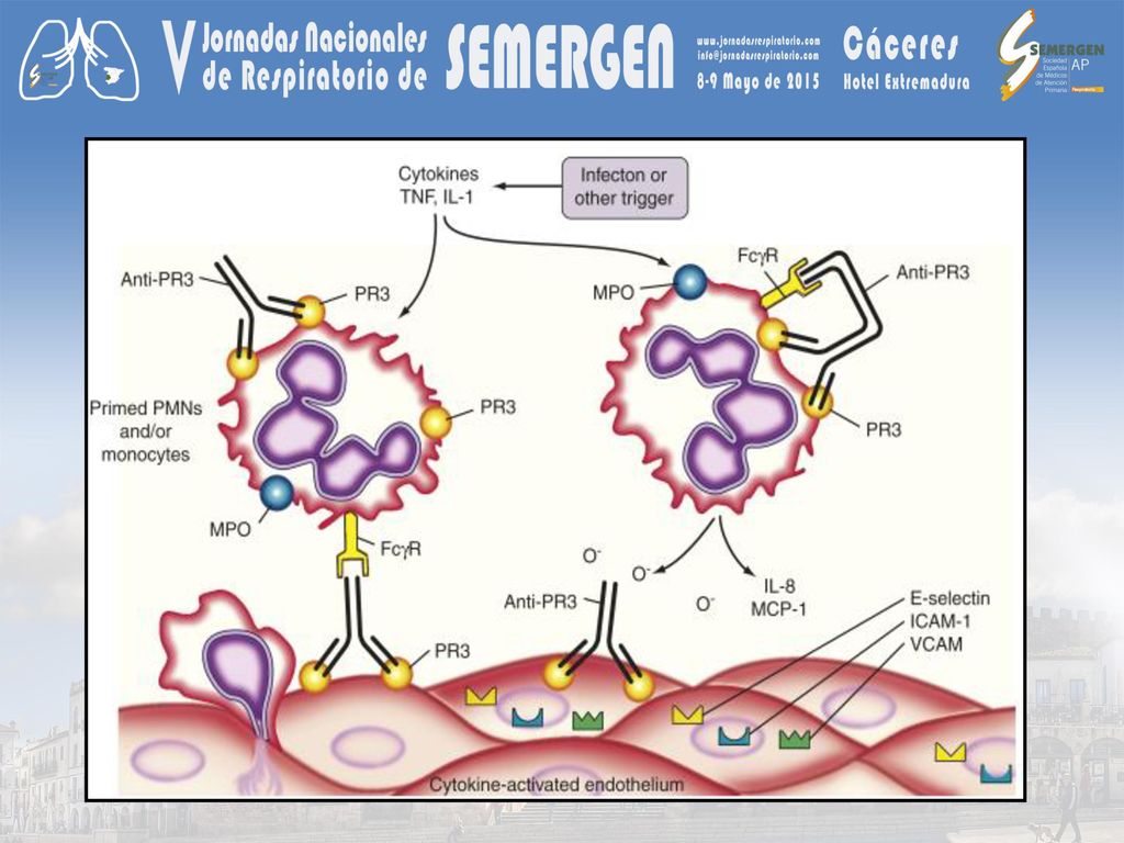 Schematic representation of the immune mechanisms hypothetically involved with antineutrophil cytoplasmic antibody (ANCA) enhancement of vascular injury. An infectious trigger or other environmental stimulus leads to a burst of cytokines, which primes the neutrophils or monocytes and may lead to the local upregulation of adhesion molecules on endothelium. The priming process within the inflammatory cells leads to enhanced expression of ANCA antigens on the cell surface. Activated neutrophils or monocytes may degranulate and release reactive oxygen species and lysosomal enzymes, leading to endothelial injury and further activation of the endothelial cell surface. The magnitude of this effect is influenced by the specificity of ANCA for proteinase 3 (PR3) or myeloperoxidase (MPO), as well as different epitopes of these respective antigens. The reaction may be further influenced by the immunoglobulin G (IgG) and Fcγ receptor phenotype engaged. Products released from degranulated inflammatory cells become bound to endothelial cells and further serve as targets of ANCA. Release of chemotactic chemokines such as interleukin-8 (IL-8) and macrophage chemoattractant protein-1 (MCP-1) serve to augment chemotaxis and inflammatory cell transmigration, in conjunction with other adhesion molecules.
