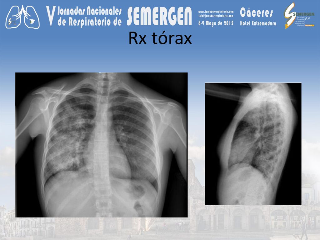 Rx tórax condensación en hemitórax derecho con broncograma aéreo y posible afectación de base izquierda.