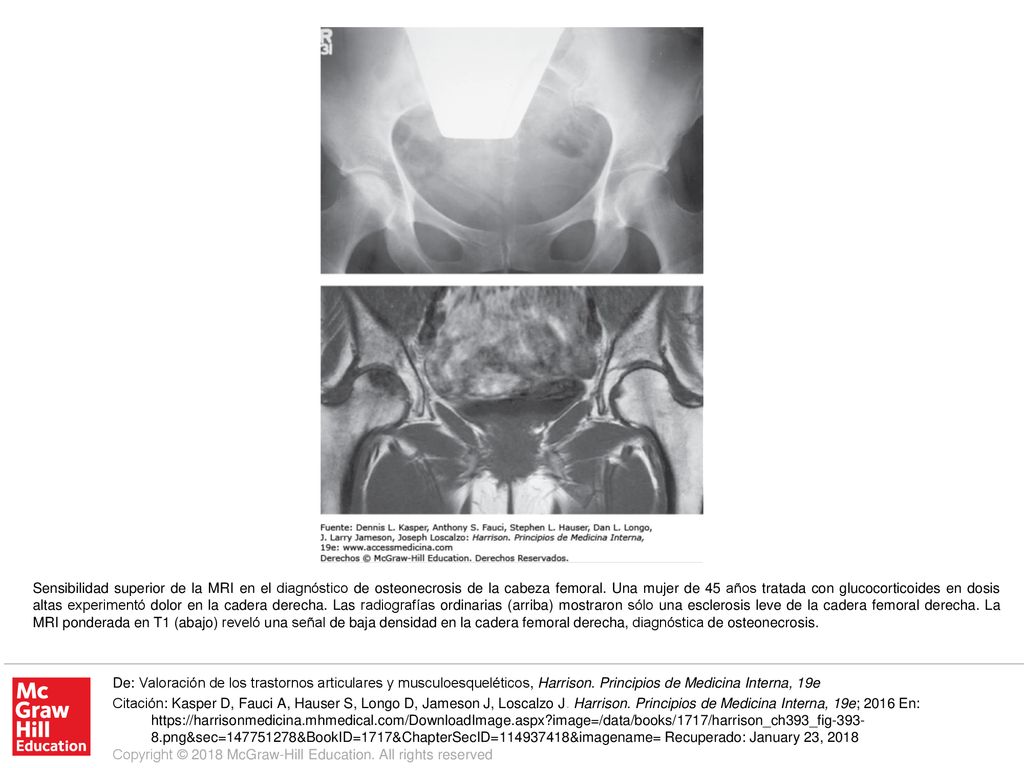 Sensibilidad superior de la MRI en el diagnóstico de osteonecrosis de la cabeza femoral. Una mujer de 45 años tratada con glucocorticoides en dosis altas experimentó dolor en la cadera derecha. Las radiografías ordinarias (arriba) mostraron sólo una esclerosis leve de la cadera femoral derecha. La MRI ponderada en T1 (abajo) reveló una señal de baja densidad en la cadera femoral derecha, diagnóstica de osteonecrosis.