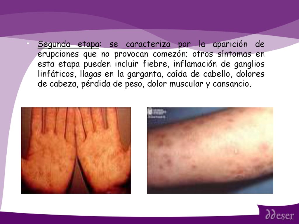 Segunda etapa: se caracteriza por la aparición de erupciones que no provocan comezón; otros síntomas en esta etapa pueden incluir fiebre, inflamación de ganglios linfáticos, llagas en la garganta, caída de cabello, dolores de cabeza, pérdida de peso, dolor muscular y cansancio.