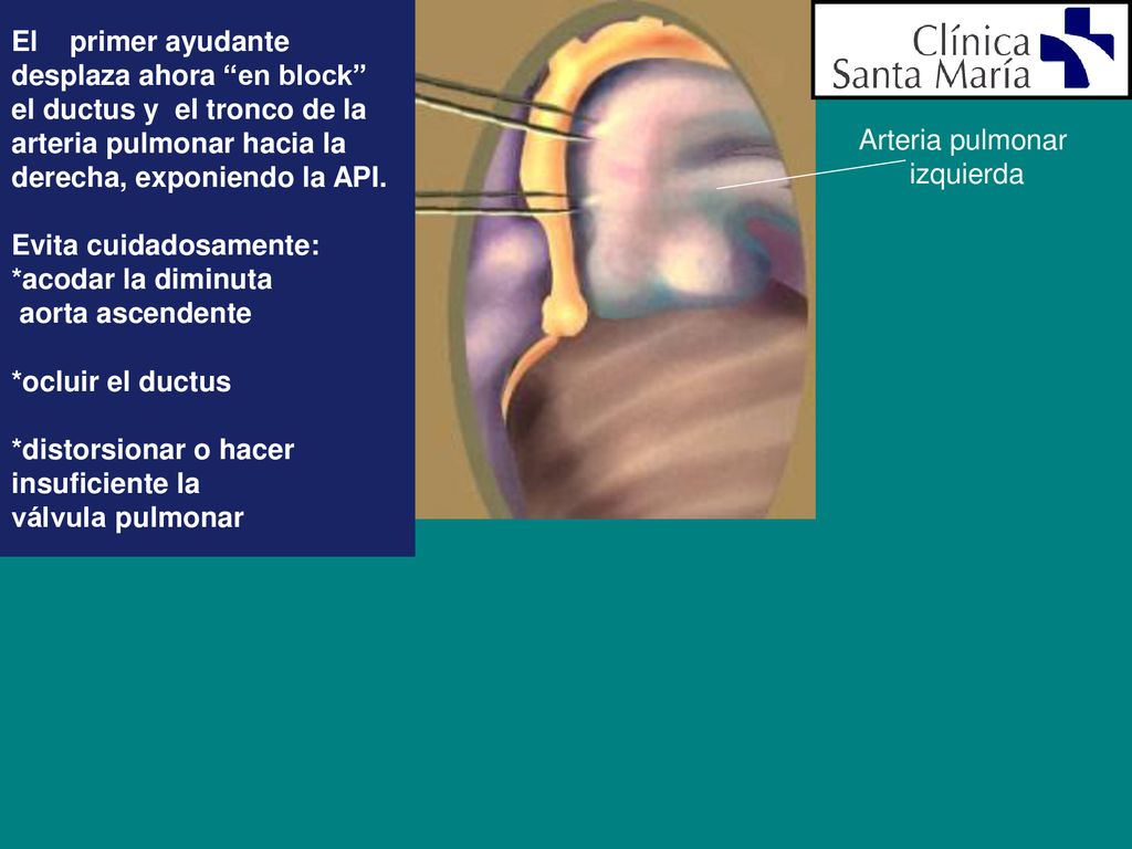 El primer ayudante desplaza ahora en block el ductus y el tronco de la. arteria pulmonar hacia la.