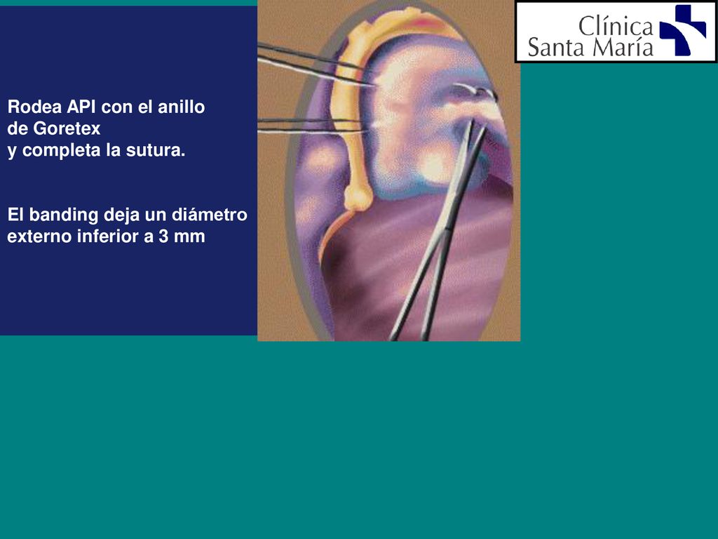 Rodea API con el anillo de Goretex. y completa la sutura.