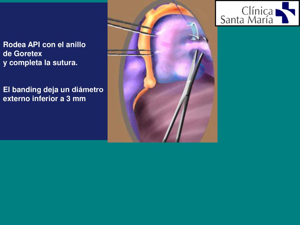 Rodea API con el anillo de Goretex. y completa la sutura.