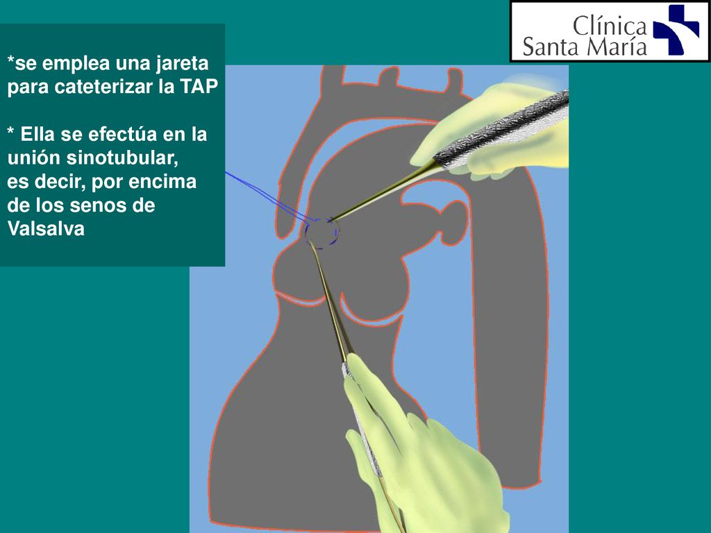 *se emplea una jareta para cateterizar la TAP. * Ella se efectúa en la. unión sinotubular, es decir, por encima.