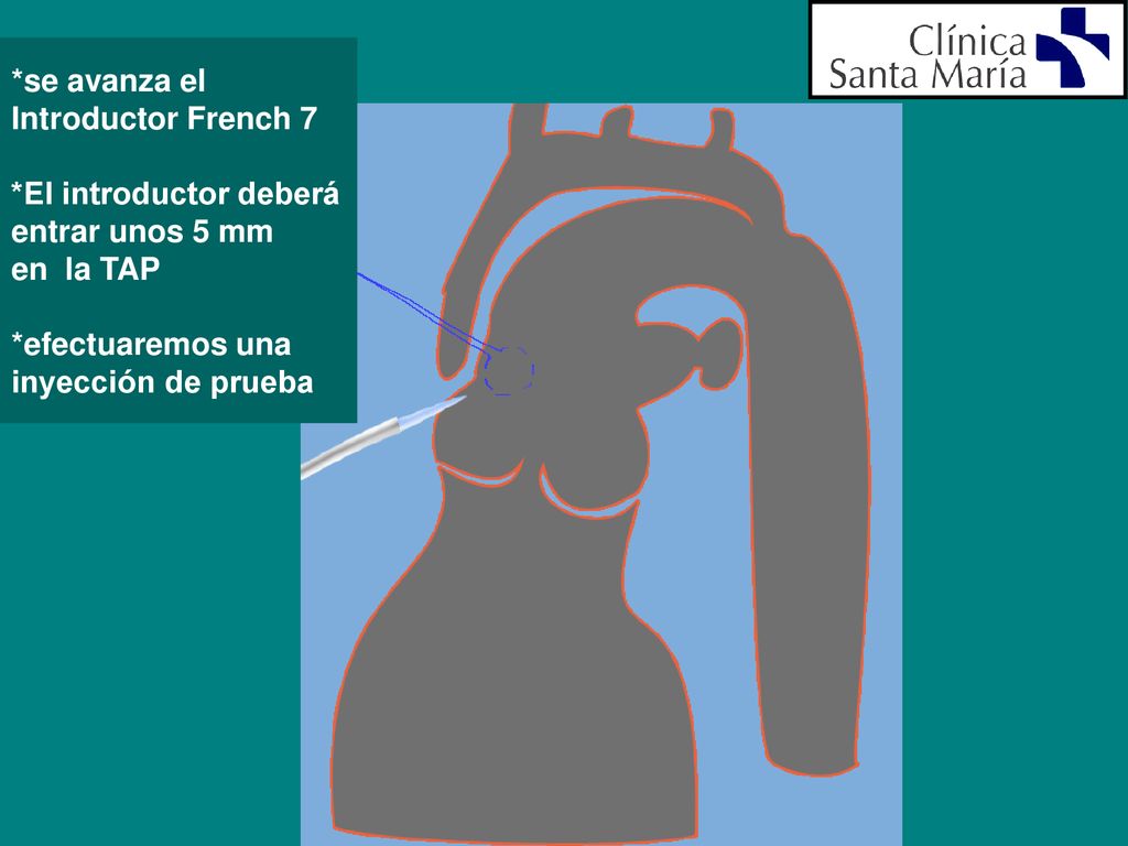 *se avanza el Introductor French 7. *El introductor deberá. entrar unos 5 mm. en la TAP. *efectuaremos una.
