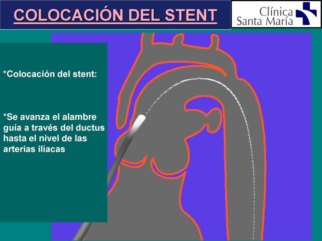 COLOCACIÓN DEL STENT *Colocación del stent: *Se avanza el alambre