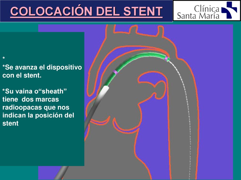 COLOCACIÓN DEL STENT * *Se avanza el dispositivo con el stent.