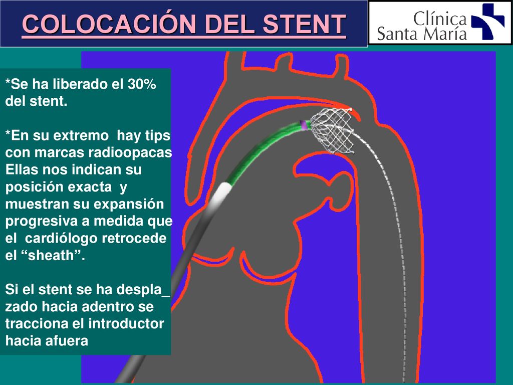 COLOCACIÓN DEL STENT *Se ha liberado el 30% del stent.