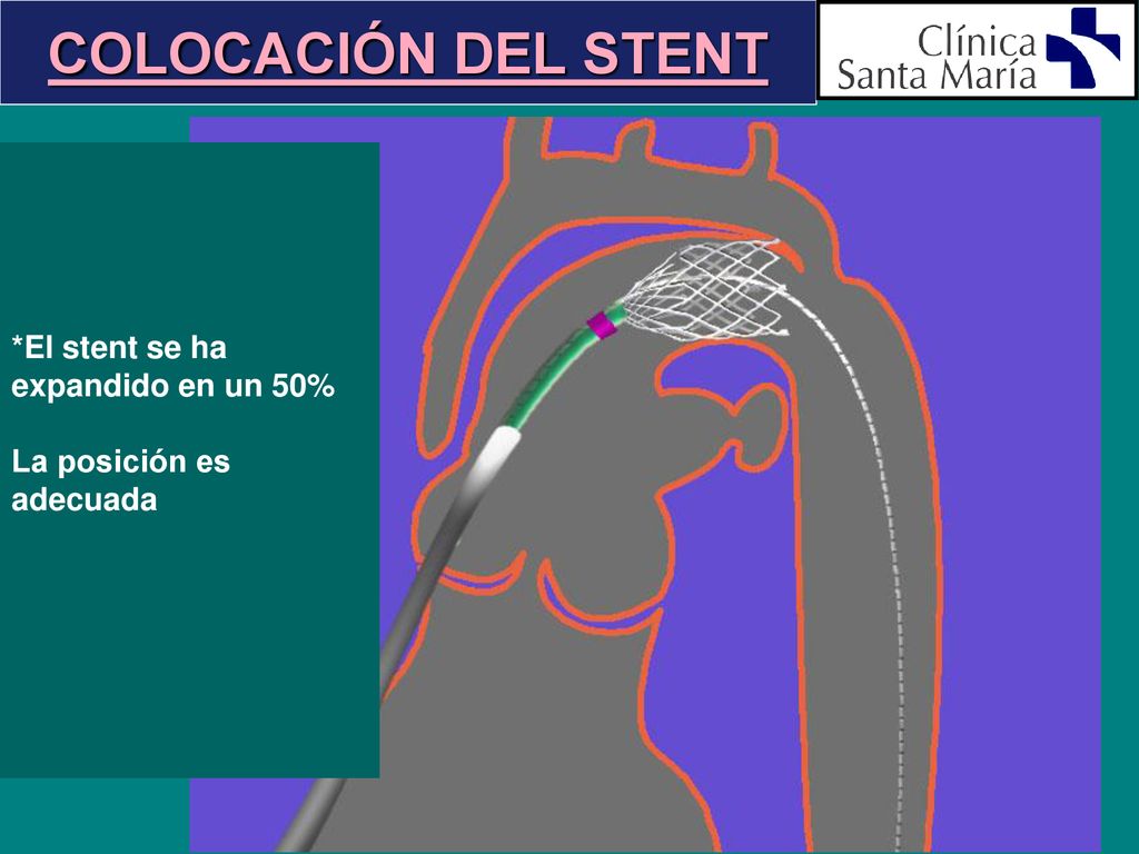 COLOCACIÓN DEL STENT *El stent se ha expandido en un 50%