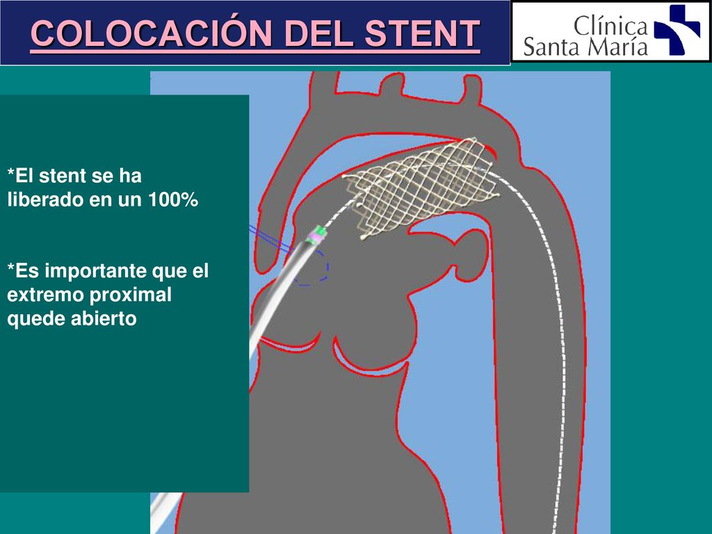 COLOCACIÓN DEL STENT *El stent se ha liberado en un 100%