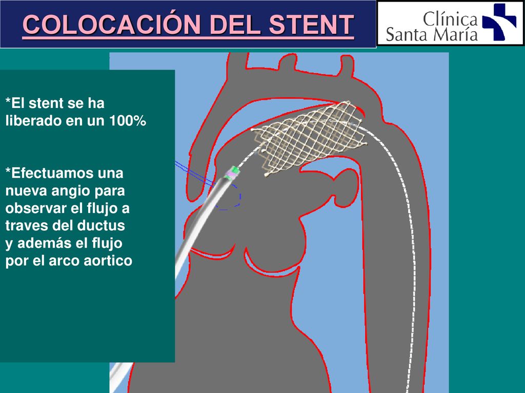 COLOCACIÓN DEL STENT *El stent se ha liberado en un 100%