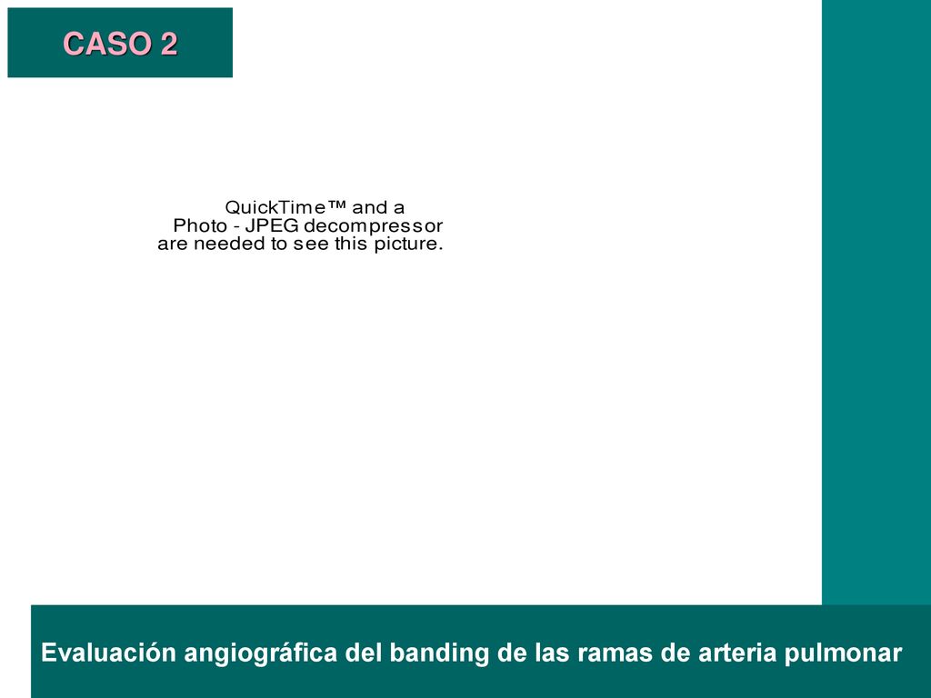 CASO 2 Evaluación angiográfica del banding de las ramas de arteria pulmonar