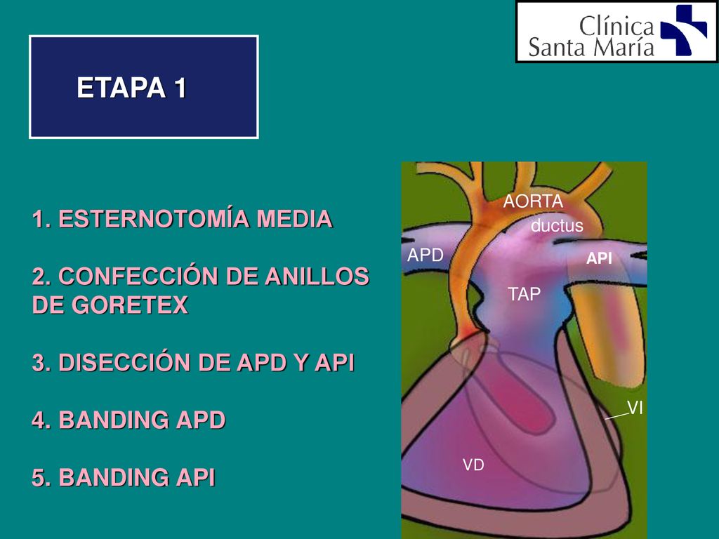 ETAPA 1 1. ESTERNOTOMÍA MEDIA 2. CONFECCIÓN DE ANILLOS DE GORETEX
