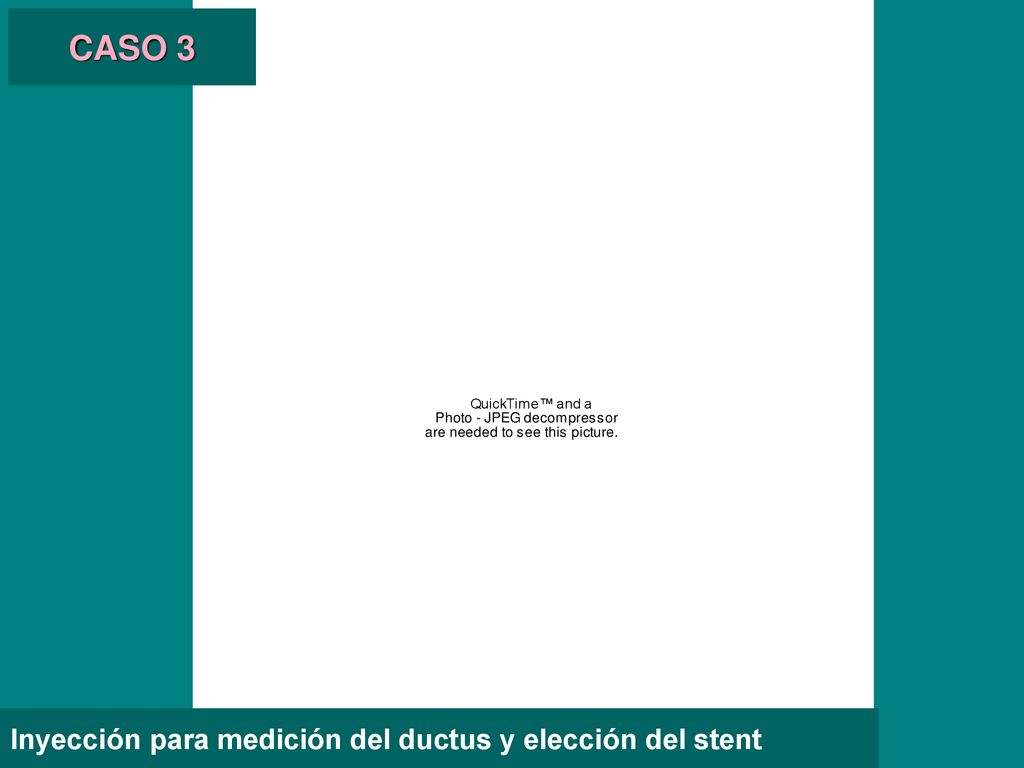 CASO 3 Inyección para medición del ductus y elección del stent