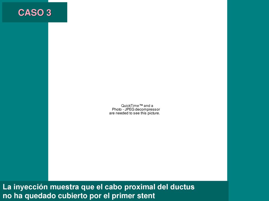 CASO 3 La inyección muestra que el cabo proximal del ductus
